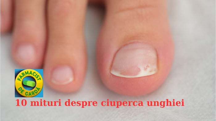 Mituri despre ciuperca unghiei